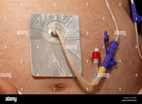 Percutaneous endoscopic gastrostomy